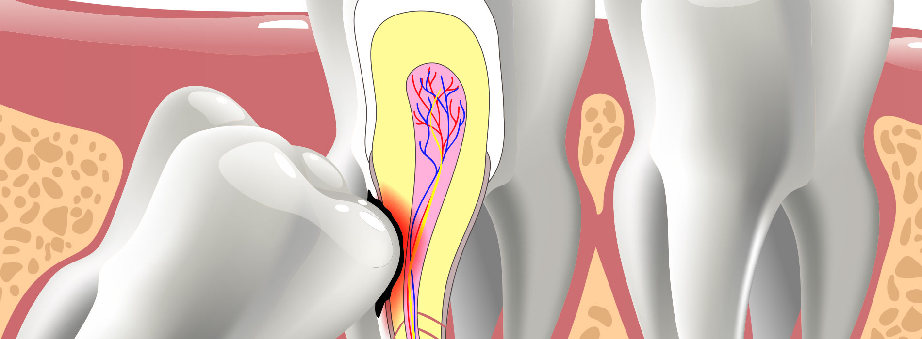 Impacted Teeth in Albuquerque