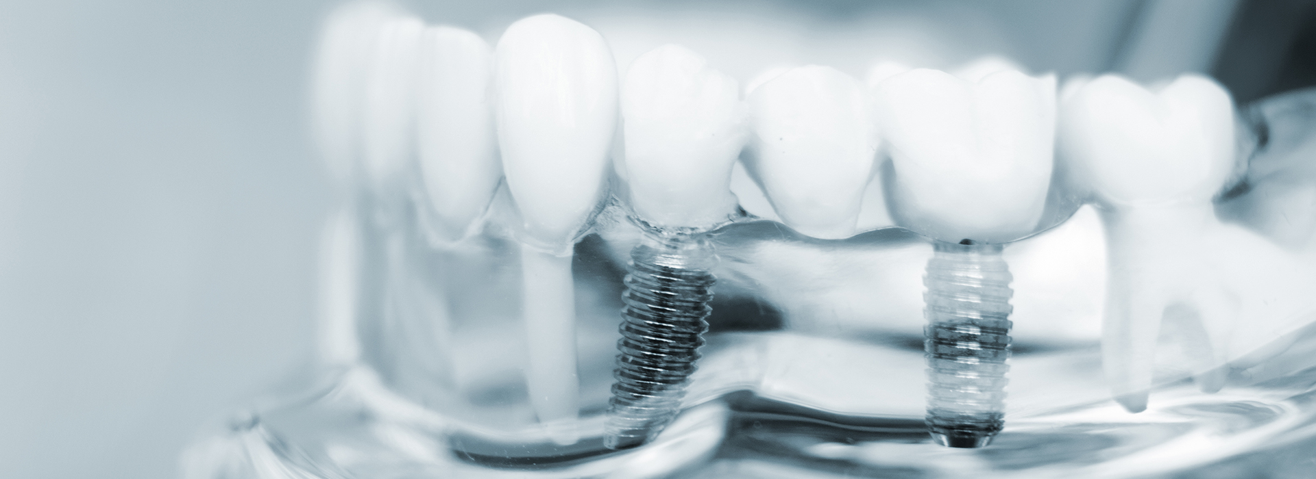 The Oral Surgery Center of Albuquerque | Bone Grafts, Extractions and Oral Pathology
